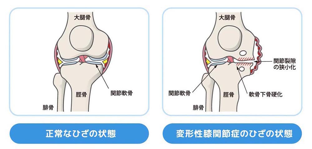 変形性膝関節症の症状