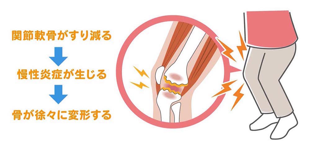 変形性膝関節症のひざの痛み