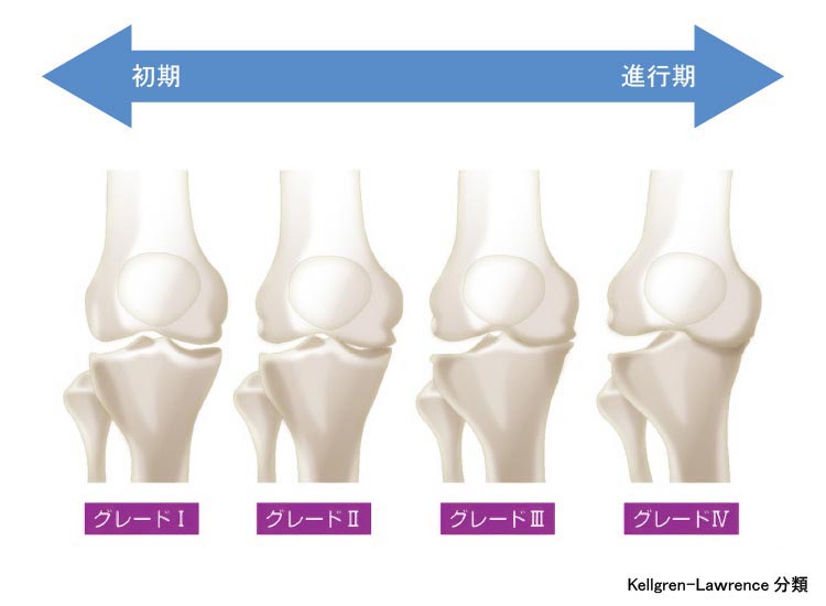 変形性膝関節症のレントゲン変化
