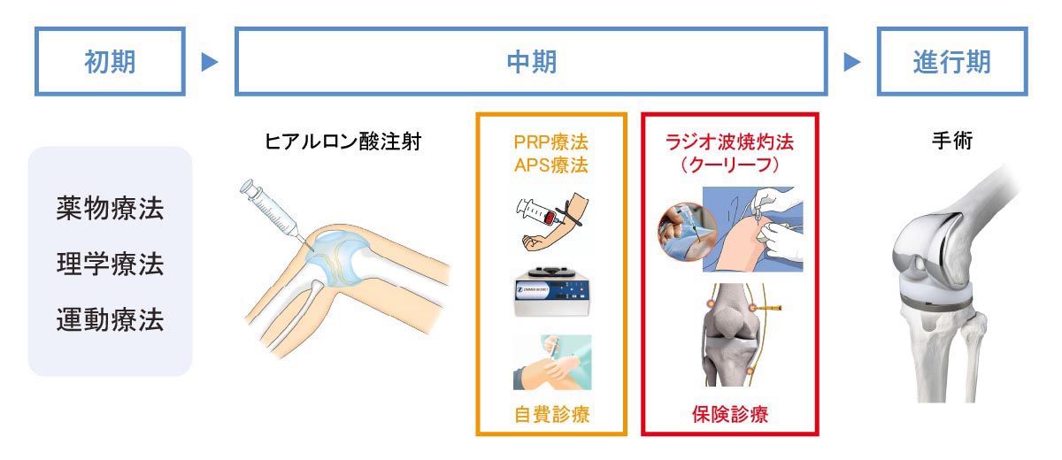 近年の変形性膝関節症の治療