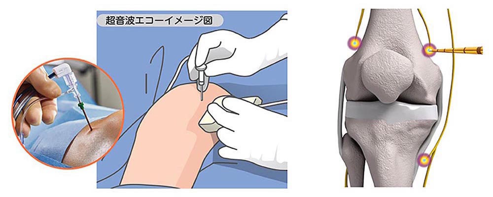 ラジオ波焼灼療法