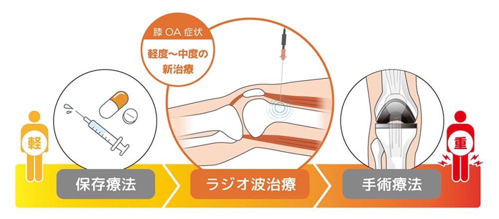 ラジオ波焼灼療法