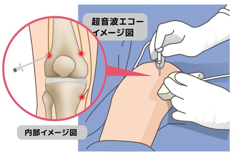 ラジオ波を当てます
