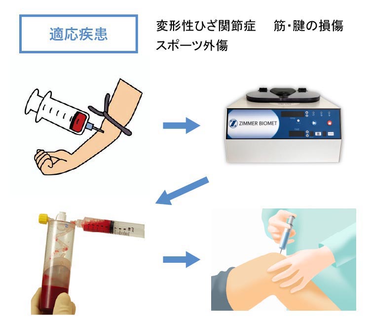 PRP療法（多血小板血漿療法）
