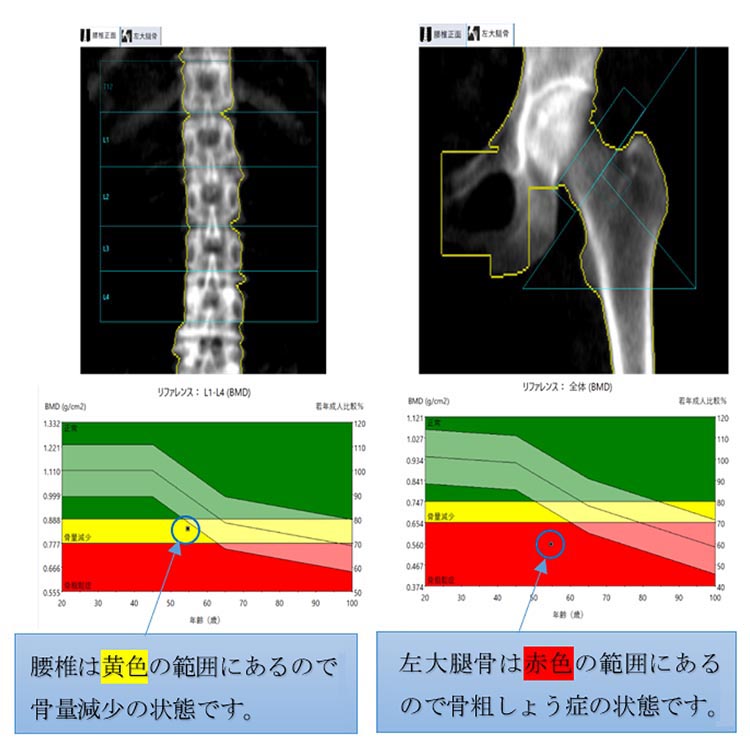 骨密度検査（DEXA法）